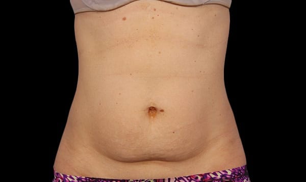 Before CoolSculpting